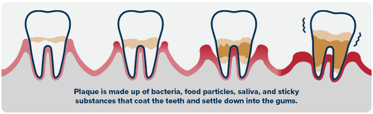 Dental plaque infographic An infographic that shows 4 different stages of plaque build-up on pets teeth.
